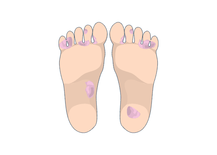 illustrations of feet with an athlete's foot